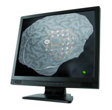 Co- registration of MRI and CT e.g. to visulaize ECoG grids